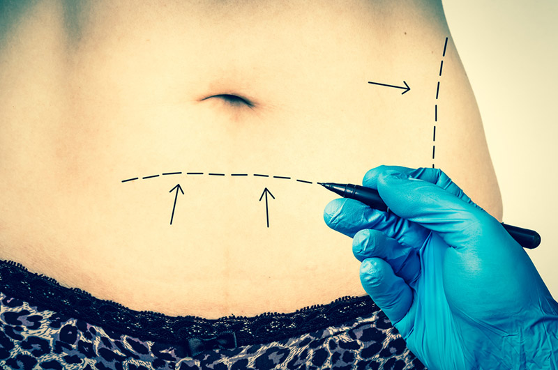 a tummy tuck in los angeles